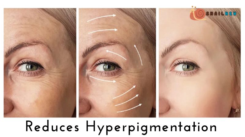 Reduces Hyperpigmentation