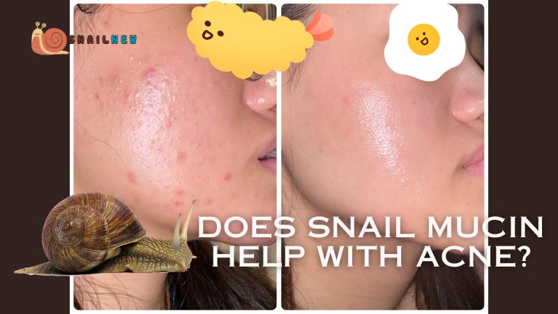 Does Snail Mucin Help with Acne?